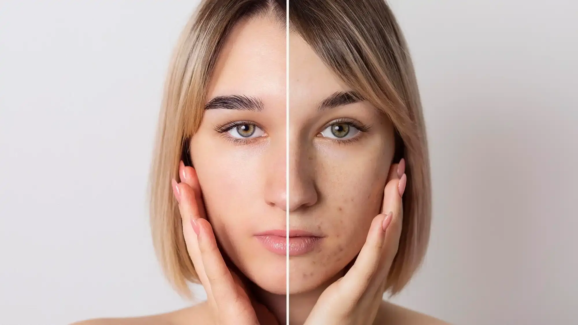 میکرونیدلینگ صورت برای جوانسازی و رفع جای جوش در تهرانپارس